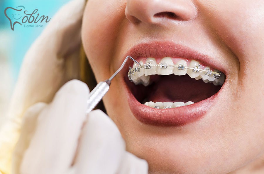 روکش دندان هایتان را به بعد از انجام ارتودنسی موکول نمایید